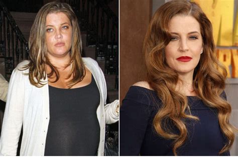 why did lisa presley have bariatric surgery